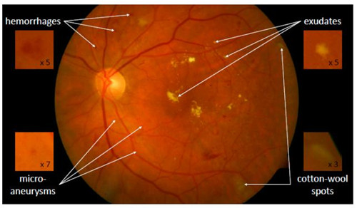 宁波材料所所属慈溪医工所开发出对早期糖尿病视网膜病变进行自动筛查
